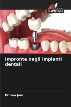 Impronte negli impianti dentali - Jain, Pritam