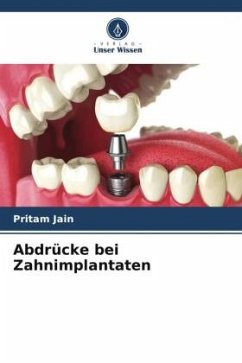 Abdrücke bei Zahnimplantaten - Jain, Pritam