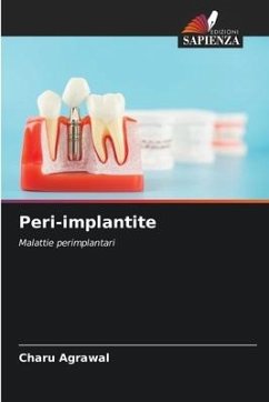 Peri-implantite - Agrawal, Charu