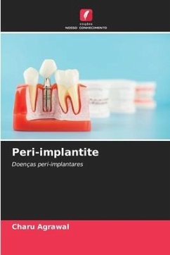 Peri-implantite - Agrawal, Charu