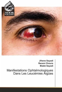 Manifestations Ophtalmologiques Dans Les Leucémies Aigües - Sayadi, Jihene;Choura, Racem;Sayadi, Malek