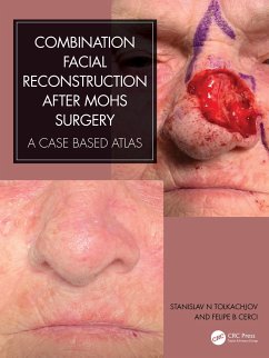 Combination Facial Reconstruction after Mohs Surgery - Tolkachjov, Stanislav N. (Mohs & Reconstructive Surgery Director, Ep; Cerci, Felipe B. (Hospital de Clinicas da Univ Federal do Parana, Br