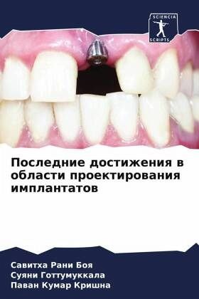 Poslednie dostizheniq w oblasti proektirowaniq implantatow Poslednie dostizheniq w oblasti proektirowaniq implantatow