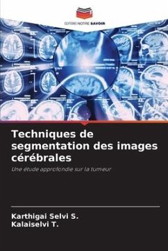 Techniques de segmentation des images cérébrales - S., Karthigai Selvi;T., Kalaiselvi