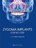 Zygoma Implants (eBook, ePUB)