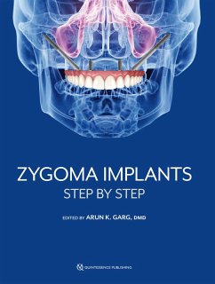 Cover Zygoma Implants (eBook, ePUB)