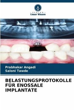 BELASTUNGSPROTOKOLLE FÜR ENOSSALE IMPLANTATE - Angadi, Prabhakar;Tawde, Saloni