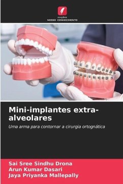 Mini-implantes extra-alveolares - DRONA, SAI SREE SINDHU;Dasari, Arun Kumar;Mallepally, Jaya Priyanka