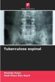 Tuberculose espinal