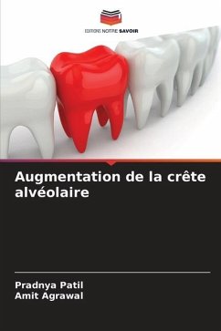 Augmentation de la crête alvéolaire - Patil, Pradnya;Agrawal, Amit