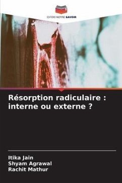 Résorption radiculaire : interne ou externe ? - Jain, Itika;Agrawal, Shyam;Mathur, Rachit