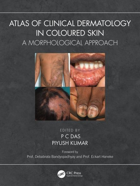 Atlas of Clinical Dermatology in Coloured Skin (eBook, ePUB) Atlas of Clinical Dermatology in Coloured Skin (eBook, ePUB)