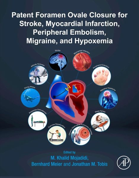 Patent Foramen Ovale Closure for Stroke, Myocardial Infarction, Peripheral Embolism, Migraine, and Hypoxemia (eBook, ePUB)