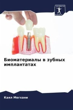 Biomaterialy w zubnyh implantatah - Meghani, Kaql
