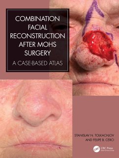 Cover Combination Facial Reconstruction after Mohs Surgery (eBook, ePUB)
