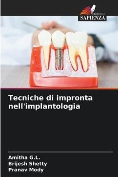 Tecniche di impronta nell'implantologia - G.L., Amitha;Shetty, Brijesh;Mody, Pranav