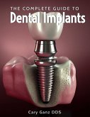 The Complete Guide to Dental Implants (All About Dentistry) (eBook, ePUB)