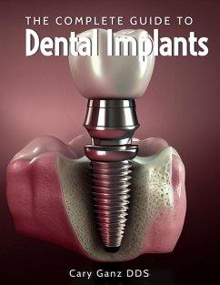 The Complete Guide to Dental Implants (All About Dentistry) (eBook, ePUB) - D. D. S., Cary Ganz