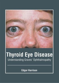 Thyroid Eye Disease: Understanding Graves' Ophthalmopathy