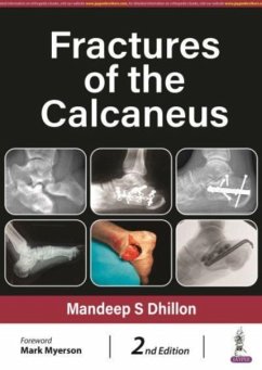 Fractures of the Calcaneus - Dhillon, Mandeep S