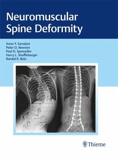 Cover Neuromuscular Spine Deformity (eBook, ePUB)