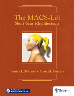 The MACS-Lift (eBook, ePUB) - Tonnard, Patrick; Verpaele, Alexis