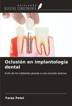 Cover Oclusión en implantología dental