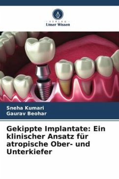 Gekippte Implantate: Ein klinischer Ansatz für atropische Ober- und Unterkiefer - Kumari, Sneha;Beohar, Gaurav