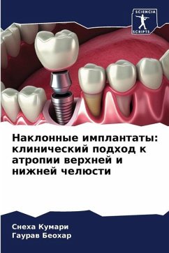 Naklonnye implantaty: klinicheskij podhod k atropii werhnej i nizhnej chelüsti - Kumari, Sneha;Beohar, Gauraw