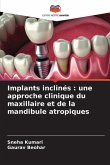 Implants inclinés : une approche clinique du maxillaire et de la mandibule atropiques