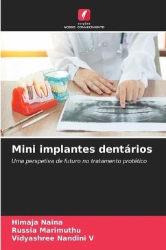 Mini implantes dentários - Naina, Himaja;Marimuthu, Russia;Nandini V, Vidyashree