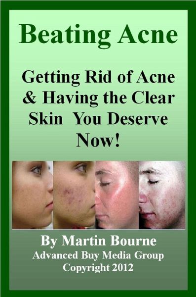 Beating Acne: Getting Rid of Acne & Having the Skin You Deserve Now! (eBook, ePUB)