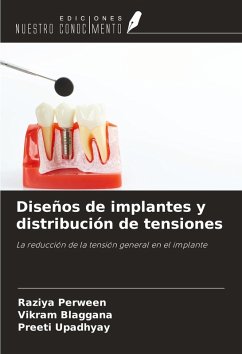 Cover Diseños de implantes y distribución de tensiones