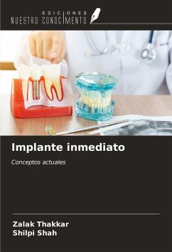 Cover Implante inmediato