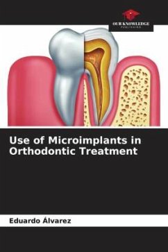 Use of Microimplants in Orthodontic Treatment - Álvarez, Eduardo