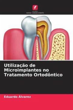 Utilização de Microimplantes no Tratamento Ortodôntico - Álvarez, Eduardo