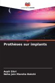 Prothèses sur implants