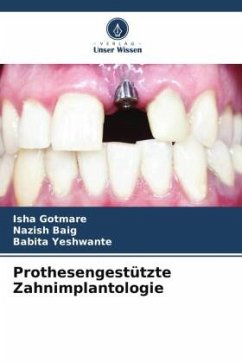 Prothesengestützte Zahnimplantologie - Gotmare, Isha;Baig, Nazish;Yeshwante, Babita