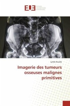 Imagerie des tumeurs osseuses malignes primitives - Aoudia, Lynda