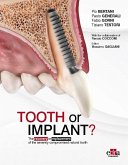 Tooth or Implant