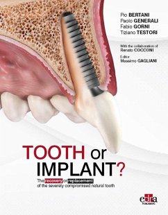 Tooth or Implant - Generali, Paolo; Gorni, Fabio; Testori, Tiziano