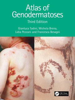 Atlas of Genodermatoses (eBook, PDF) - Tadini, Gianluca; Brena, Michela; Besagni, Francesca; Pezzani, Lidia