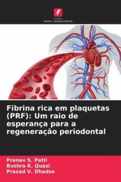 Fibrina rica em plaquetas (PRF): Um raio de esperança para a regeneração periodontal - Patil, Pranav S.;K. Quazi, Bushra;Dhadse, Prasad V.