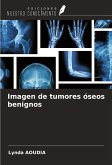 Imagen de tumores óseos benignos