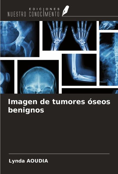 Imagen de tumores óseos benignos