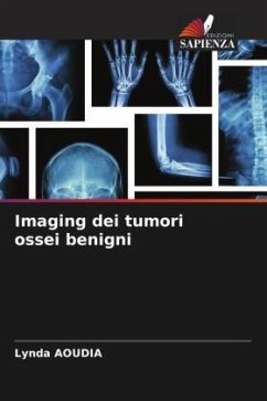 Imaging dei tumori ossei benigni - Aoudia, Lynda
