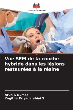 Vue SEM de la couche hybride dans les lésions restaurées à la résine - J. Kumar, Arun;Priyadarshini S., Yogitha