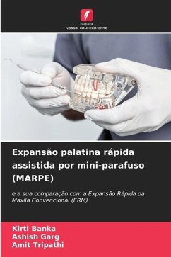 Expansão palatina rápida assistida por mini-parafuso (MARPE) - Banka, Kirti;Garg, Ashish;Tripathi, Amit