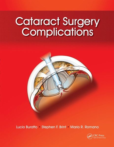 Cataract Surgery Complications (eBook, ePUB)