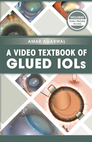 A Video Textbook of Glued IOLs (eBook, ePUB)